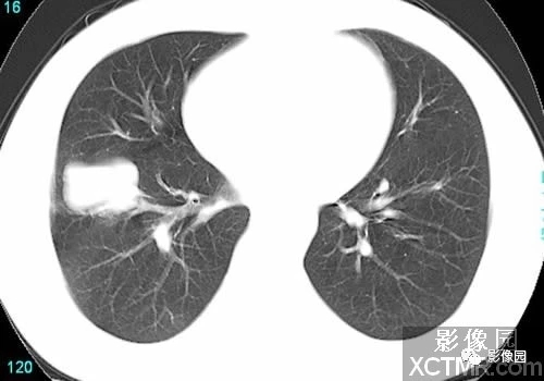 【病例】右肺下叶小细胞<font color="red">癌</font>CT病例图片影像诊断分析！