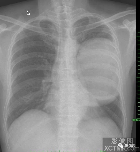【肺癌肉瘤】X线-CT病例图片影像诊断分析！