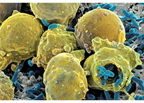 Lancet Oncology：華中科技大學吳鵬等團隊合作探討了影響宮頸小細胞癌患者預后的因素和治療方法