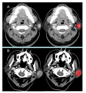 academic radiology：基于CT放射组学的腮腺多<font color="red">形</font>腺瘤与Warthin<font color="red">肿瘤</font>的无创鉴别诊断