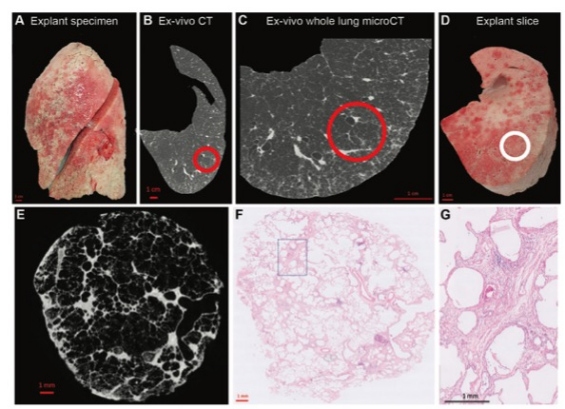 Radiology：肺早期肺间质改变的影像学和组织学关系