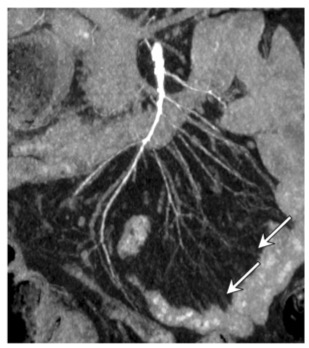 European Radiology：非阻塞性肠系膜缺血(NOMI)患者的MDCT表现