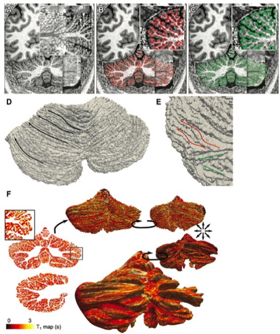 Radiology：高分辨率7.0 T MRI对小脑的形态学测量