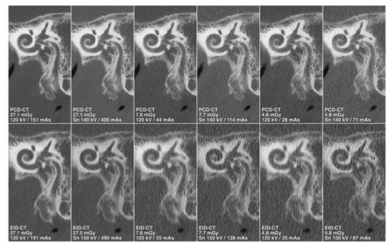 Investigative Radiology：超高分辨率光子计数探测器CT的颞骨光谱成像