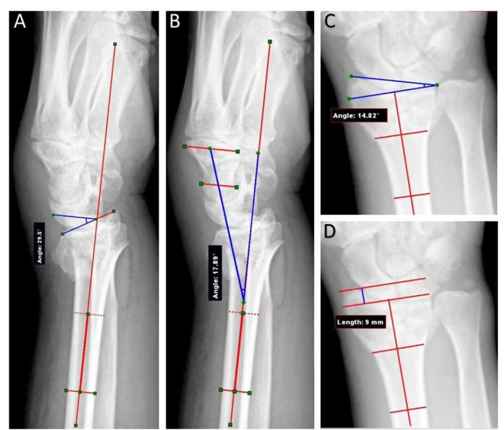 BMC Musculoskelet Disord：应用外固定架治疗桡骨远端骨折的疗效:平行于桡骨轴和垂直于桡骨远端<font color="red">关节</font>面两个施力方向的随机临床试验比较