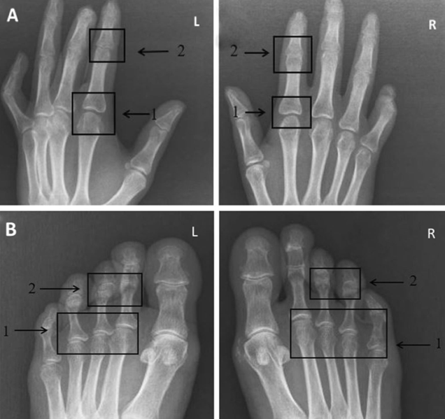 《BMC Rheumatology》：系统性硬化症的手足影像学变化