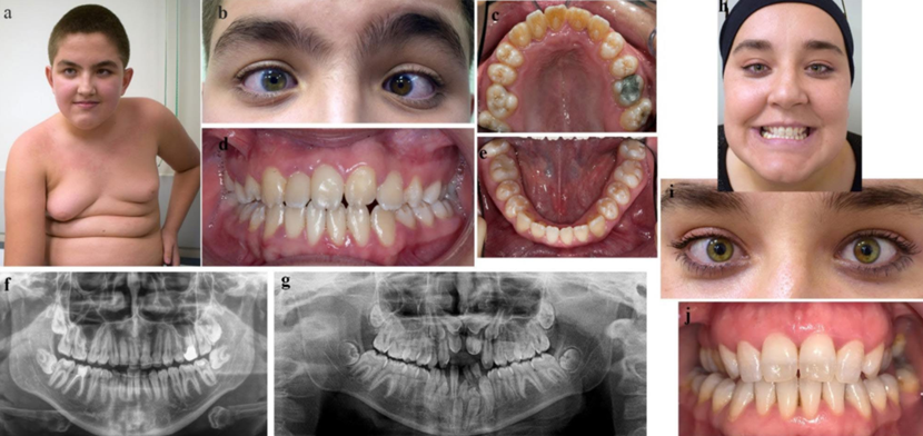 Nance-Horan综合征:三个新诊断家庭的牙齿、临床和分子特征