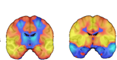 JAMA NEURO：病变相关的癫痫脑网络地图绘制有助于高风险患者识别