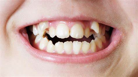 BMC Oral Health：牙周和口腔卫生状况与血清HbA1c水平的关系及比较