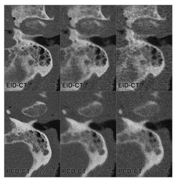Investigative Radiology：超低剂量光子计数CT对副鼻窦的锡预滤成像:我们究竟能达到多低?