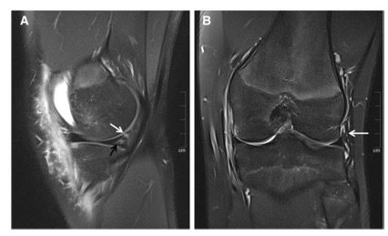 European Radiology：膝关节韧带撕裂和斜坡损伤的频率代表了什么？