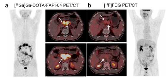 European Radiology:PET/<font color="red">CT</font>在胰腺癌诊断及预后预测中的附加价值