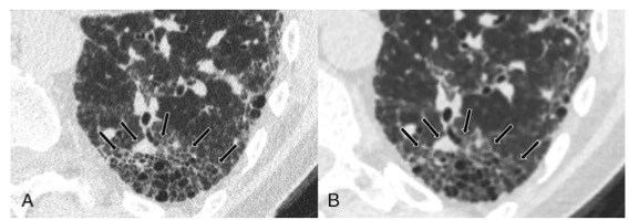 Investigative Radiology：光子计数检测器CT在诊断寻常间质性肺炎中的临床价值 