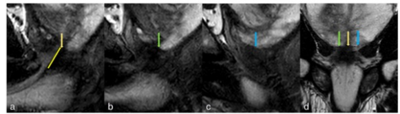 European Radiology：在前列腺MRI上测量膜性尿道长度(MUL)的标准化方法 