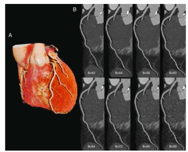 Investigative Radiology：光子计数检测器CT在超高分辨率冠状动脉CTA中的应用
