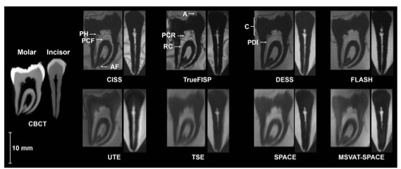 Investigative Radiology:高分辨率牙齿<font color="red">MRI</font>是否可与CBCT竞争?