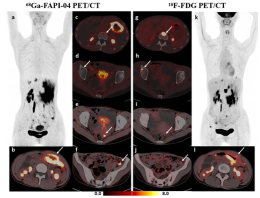 European Radiology：双示踪<font color="red">PET</font>/CT在胃癌初步评估中的应用