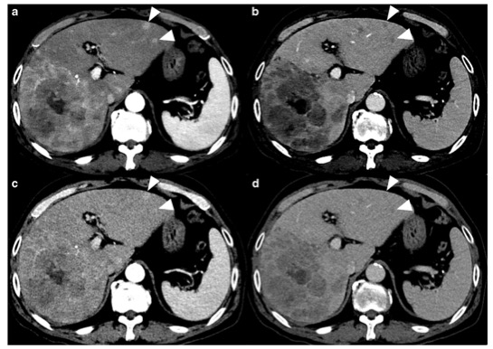 European Radiology：如何实现肝脏CT图像的“减量不减价”？