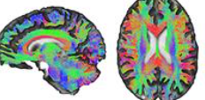 Annals of Neurology：双<font color="red">侧</font>大脑半球间结构连通性是卒中后运动恢复的基础
