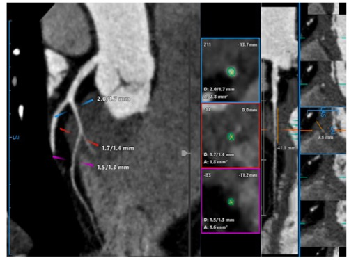 European Radiology：如何<font color="red">准确</font><font color="red">预测</font>心肌桥患者复发性胸痛的发生？ 