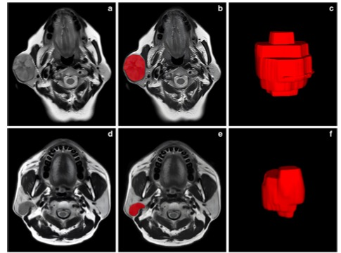 European Radiology:T2加权放射组学模型在鉴别腮腺<font color="red">Warthin</font>瘤和多形性腺瘤中的价值