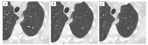 Eur J Radiol：肺癌筛查中的超低<font color="red">剂量</font>CT扫描方案