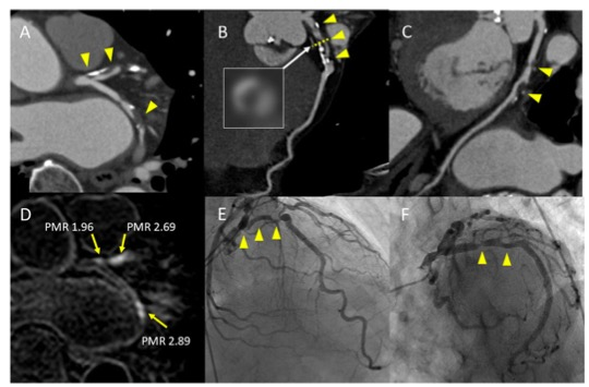 European Radiology：冠状动脉斑块特征对围手术期心肌损伤的影响