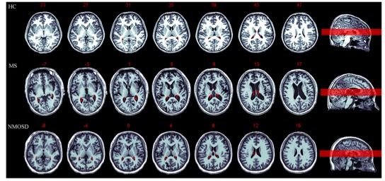 European Radiology：多发性硬化症的皮质萎缩与脉络扩张有关