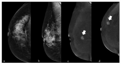 Academic Radiology：BI-RADS及乳腺钼靶增强在乳腺癌中的应用