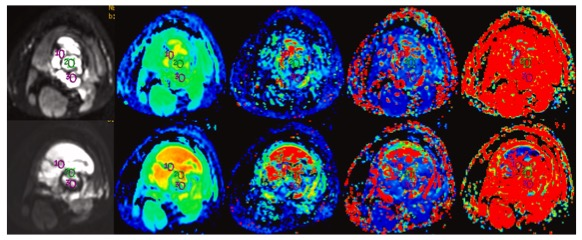 Eur J Radiol：骨肉瘤患者新辅助化疗反应的MRI评估