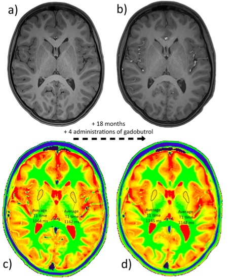 European Radiology：<font color="red">钆</font>剂在儿童脑沉积的MRI T1-Mapping研究