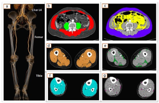 European Radiology：<font color="red">周围</font>动脉疾病患者的下肢肌肉萎缩的定量CT测量与评估