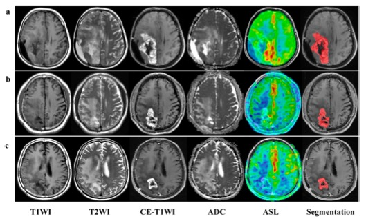 European Radiology：DWI和<font color="red">ASL</font>放射组学特征在区分胶质瘤复发和辐射损伤中的应用