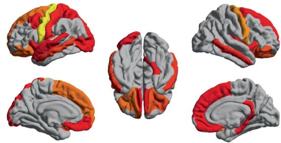 Nature Aging：复旦大学发现，睡眠时间、认知和心理健康之间非线性关联的大脑<font color="red">结构</font>和<font color="red">遗传</font>机制