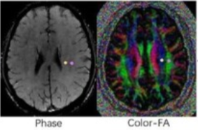 Age Ageing：浙大<font color="red">学者</font>发现脑淋巴系统在衰老有关的认知能力下降中的作用