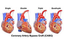 Cardiovasc Diabetol：甘油三酯-葡萄糖指数预测无糖尿病者冠脉搭桥术后不良<font color="red">心血管事件</font>