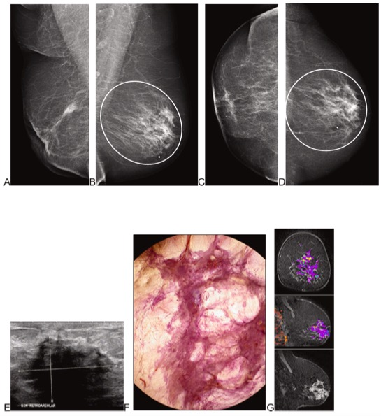 Eur J Radiol：弥漫性浸润性乳腺癌的影像学及组织病理学特征