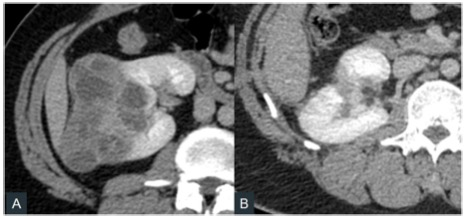 European Radiology：预测肾脏部分切除术患者长期漏尿的术前CT评估