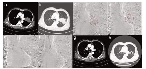 Eur J Radiol：支气管动脉化疗栓塞治疗在晚期鳞状细胞肺癌中的应用