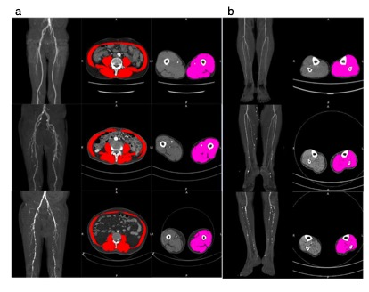 European Radiology:外周动脉疾病患者下肢肌肉萎缩的CT定量评估