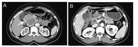 Eur J Radiol：胰腺神经内分泌肿瘤的哪些影像学表现可用于预后预测？