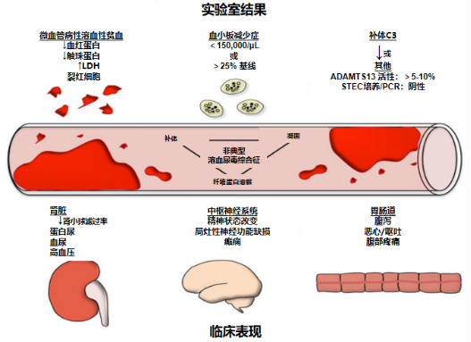 溶血合并肾功能相关三联征，是否该考虑补体旁路途径失调？