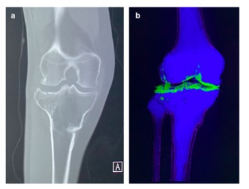 European Radiology：双能<font color="red">CT</font>在下肢骨折方面的价值