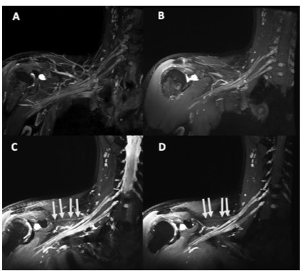 Radiology:肱神经丛三维MR成像的对比剂选择