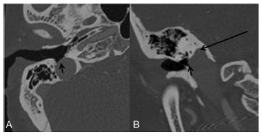 European Radiology：单侧搏动性耳鸣伴颈静脉球壁裂的CT影像学评估