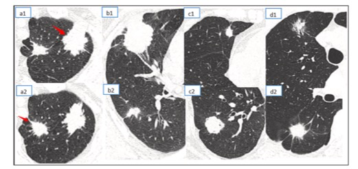 Eur J Radiol：多发性原发肺癌和肺内转移的CT放射组学无创鉴别