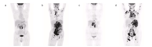 Eur J Radiol:基线PET/CT对弥漫性大b细胞淋巴瘤患者的风险分层及预后评估