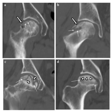 European Radiology：CT和MRI在股骨头坏死早期分期中的价值