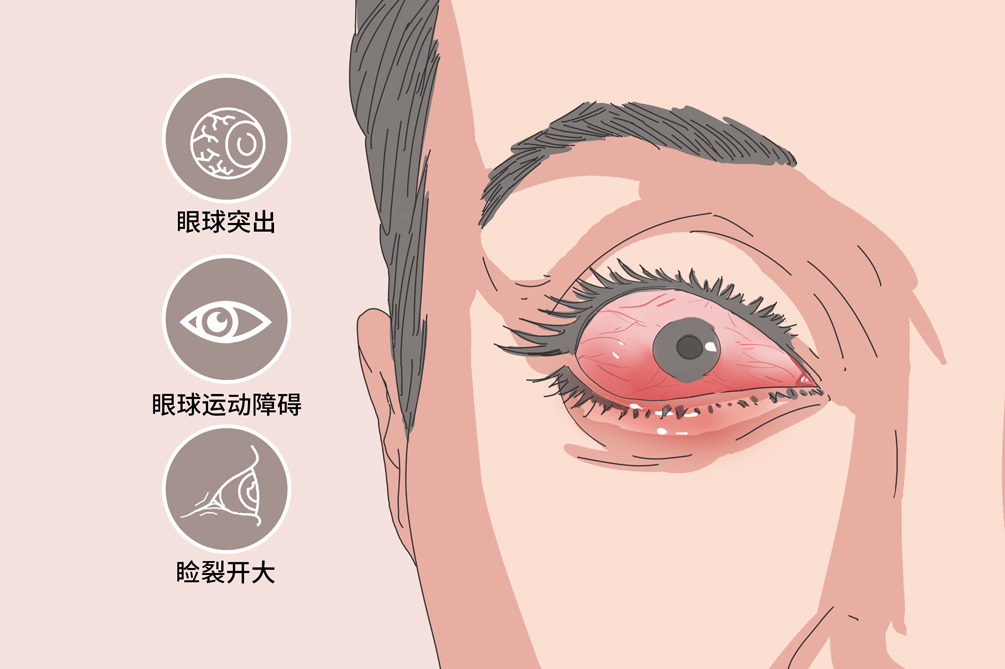 Endocrine：Graves眼病患者每周大剂量<font color="red">甲</font><font color="red">强龙</font>治疗12周后，骨转换率下降，骨结构改善