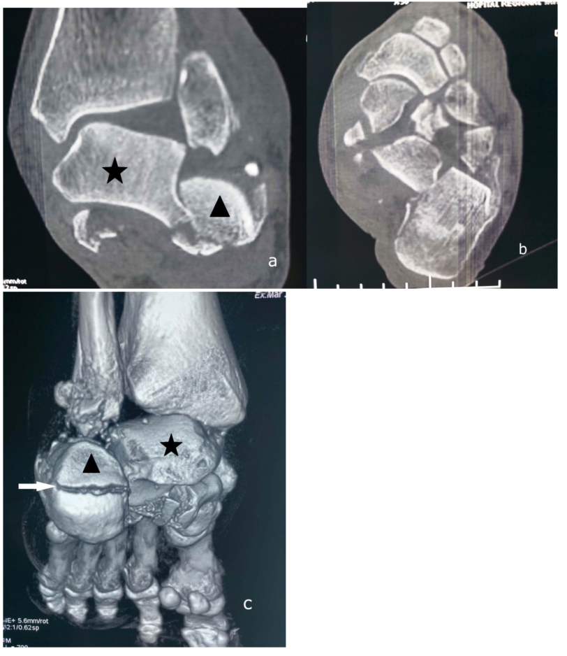 Trauma Case Rep：外侧距下关节脱位合并跟骨骨折和外踝骨折的罕见病例 